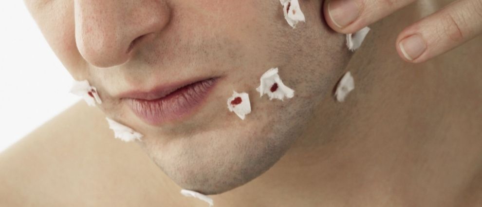 Rapaz com o rosto machucado após fazer a barba incorretamente.